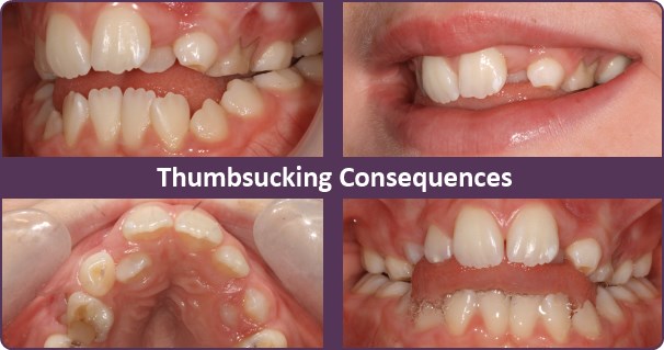 thumbsucking-consequences-1